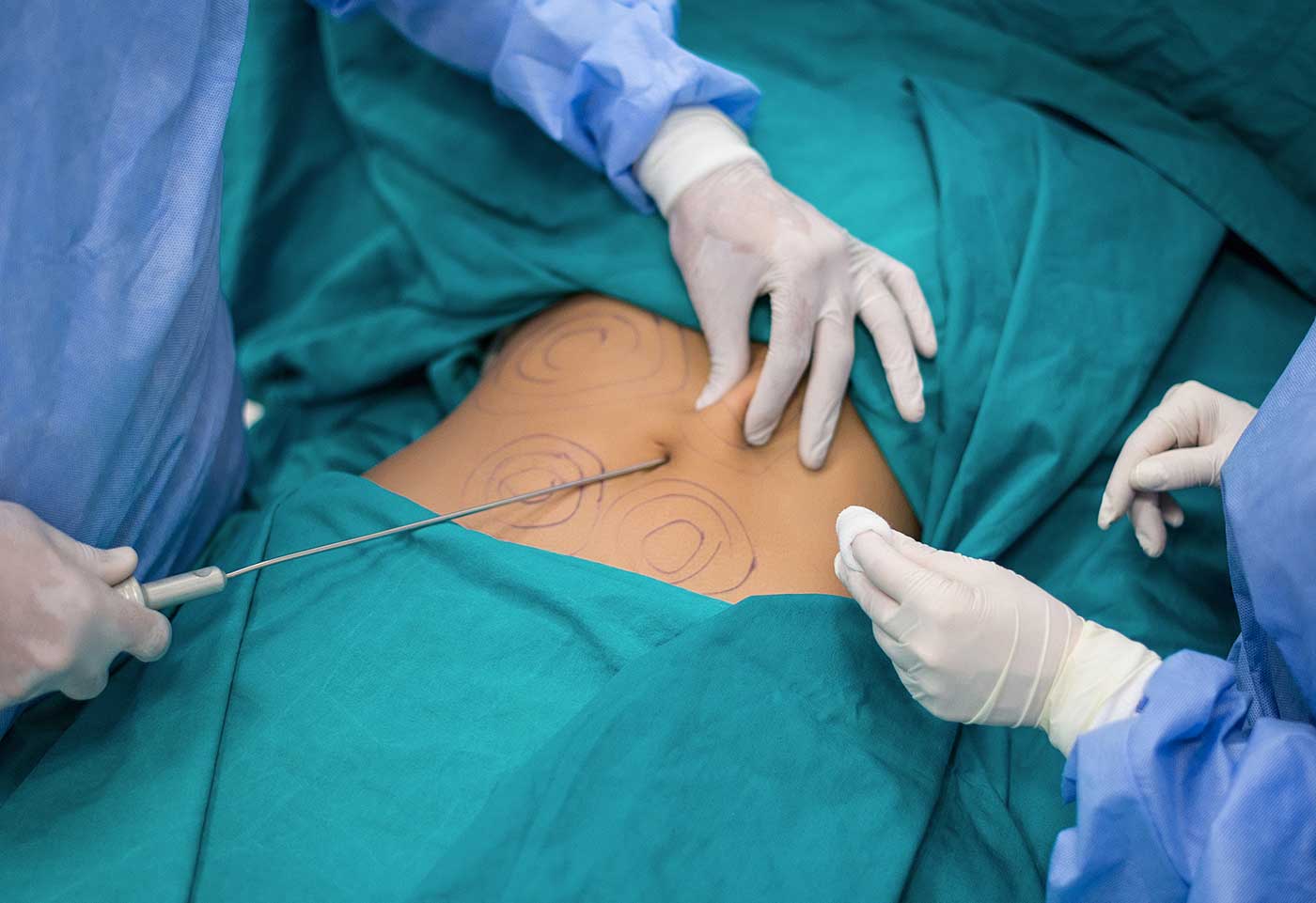 LA LIPOASPIRATION