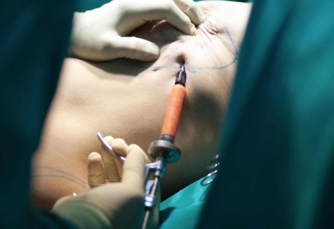 LIPOFILLING MAMMAIRE