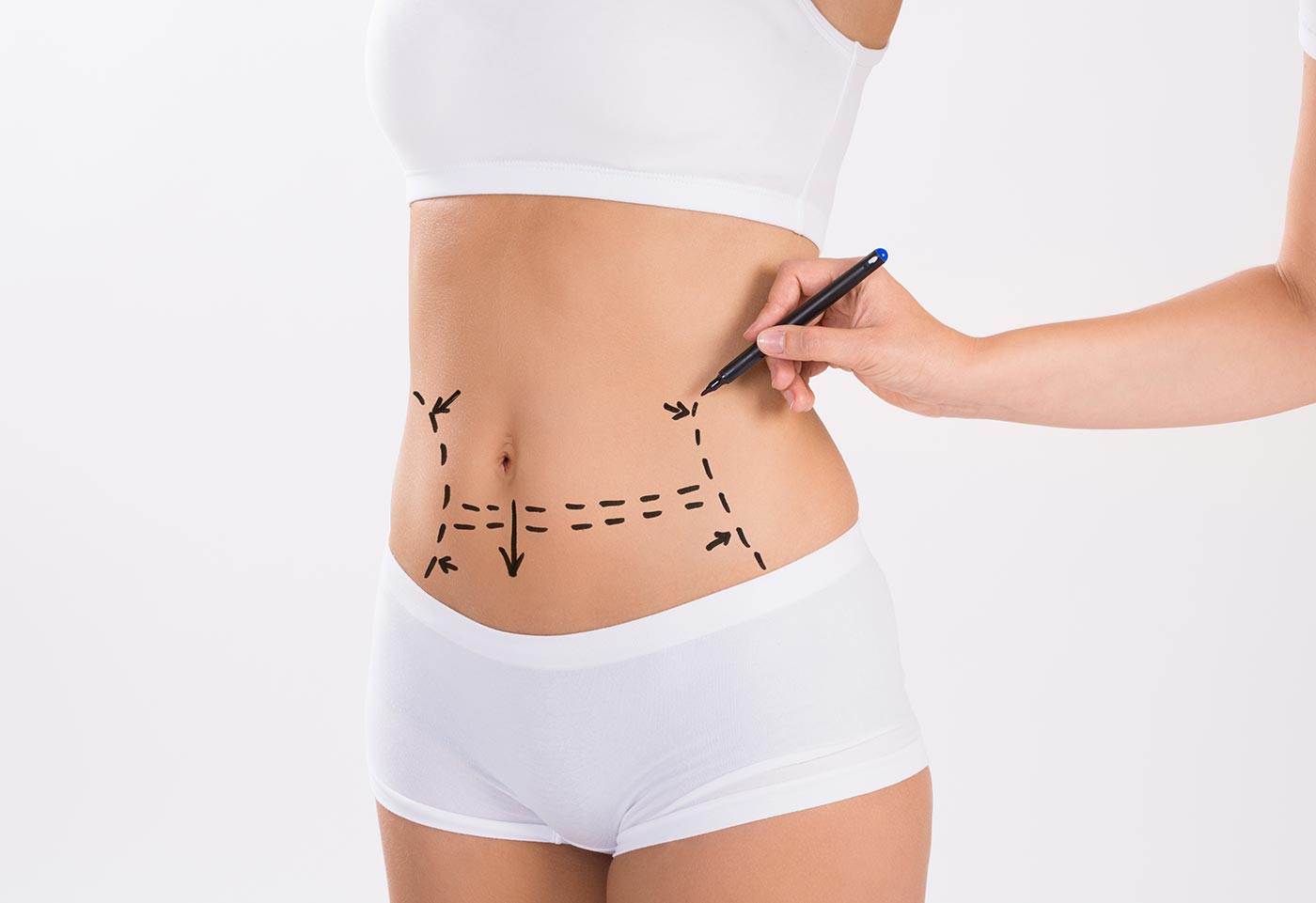 L'abdominoplastie