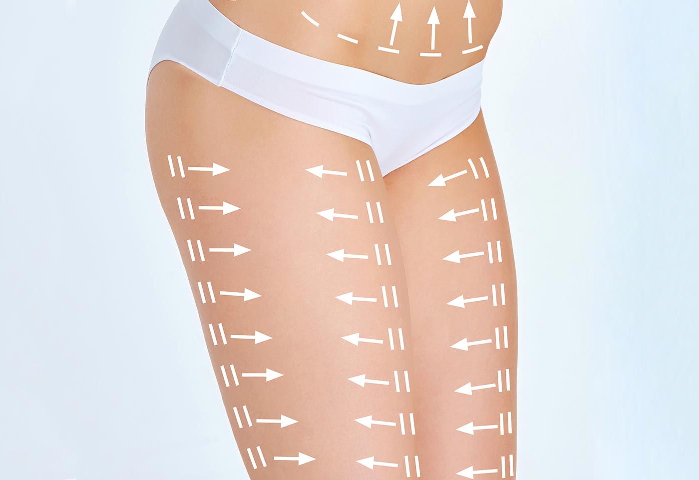 Le lifting des cuisses