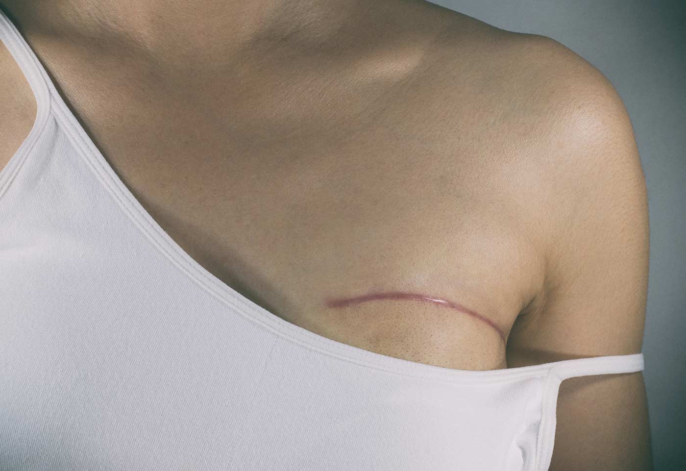 chirurgie des cicatrices