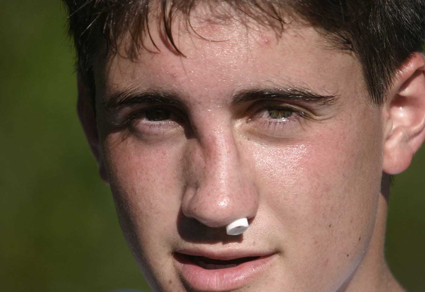 rhinoplastie traumatique