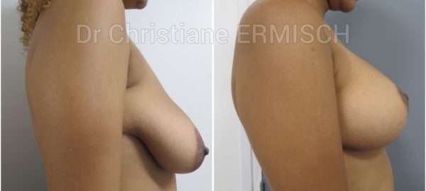 ASYMÉTRIE MAMMAIRE 3