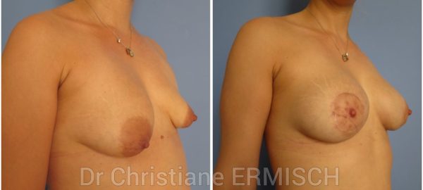 ASYMÉTRIE MAMMAIRE 5