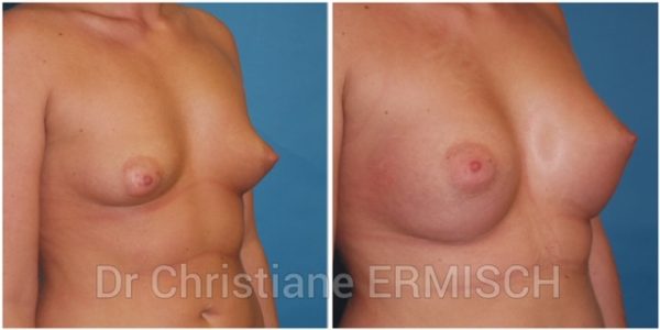 AUGMENTATION MAMMAIRE 1