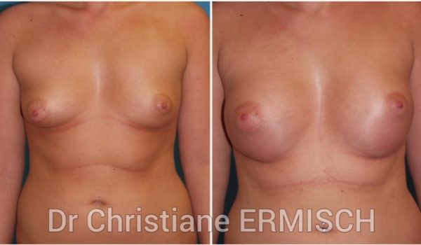 AUGMENTATION MAMMAIRE 2