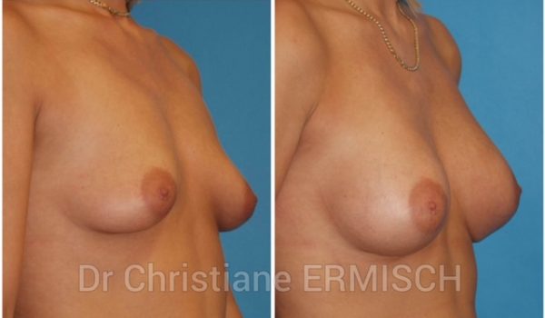 AUGMENTATION MAMMAIRE 4