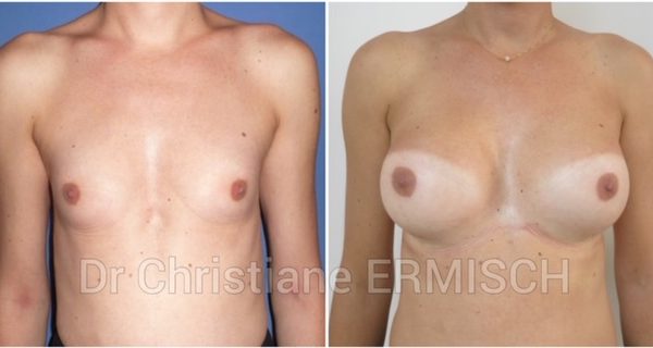 AUGMENTATION MAMMAIRE 5