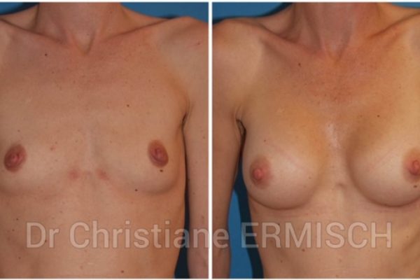 AUGMENTATION MAMMAIRE 6