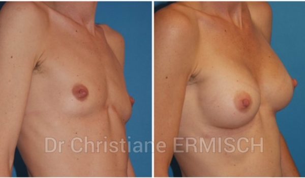 AUGMENTATION MAMMAIRE 7