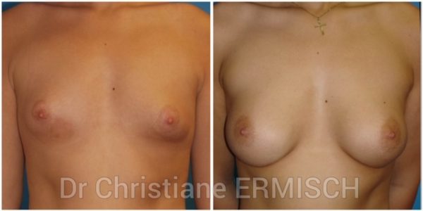 AUGMENTATION MAMMAIRE 8