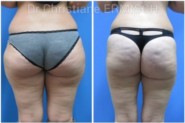 Le lifting des cuisses 2