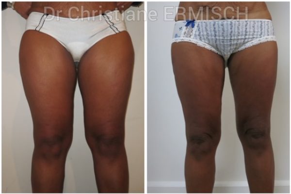 Le lifting des cuisses 3