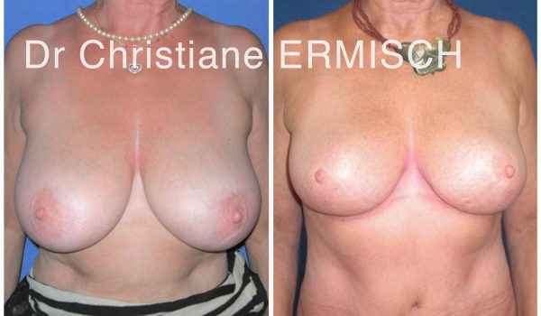 PLASTIE MAMMAIRE 1