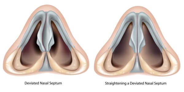 chirurgie du nez