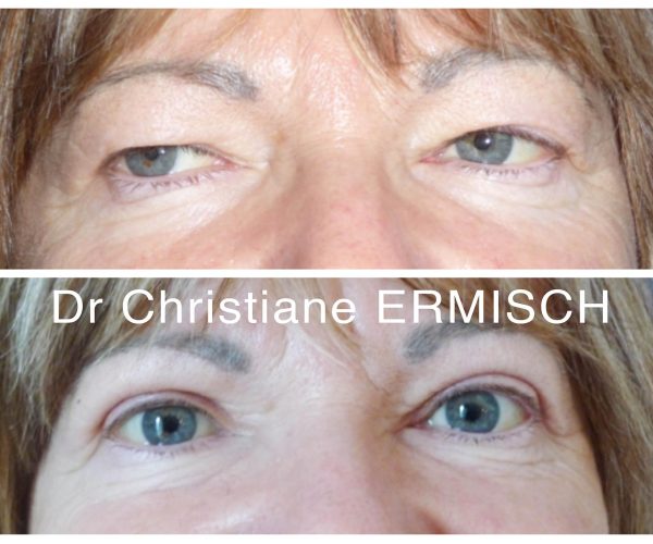 chirurgie paupières 1