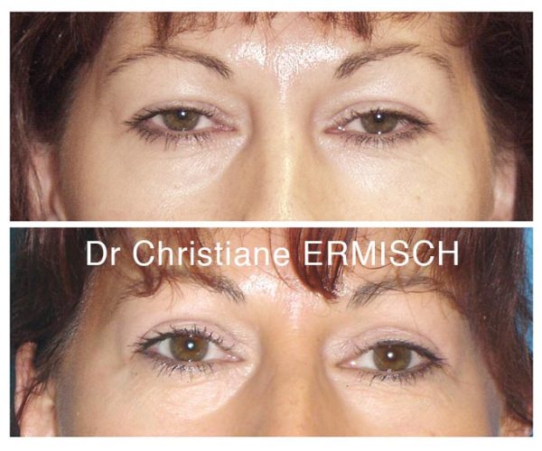 chirurgie paupières 2