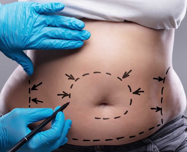 plastie abdominale