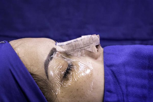 reconstruction nez